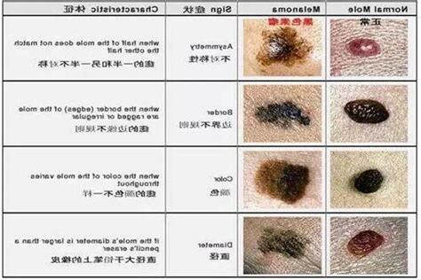 痣有變化