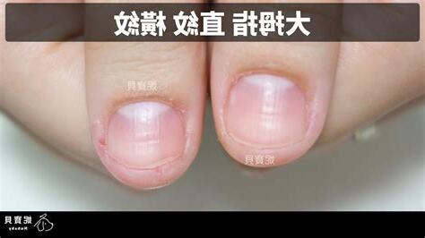 大拇指橫紋