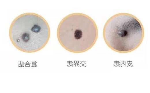 和合痣