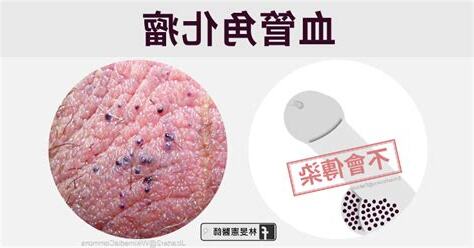 睪丸有痣