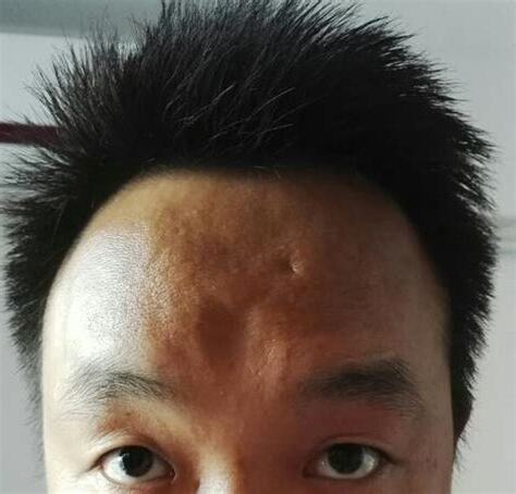 额头凹陷
