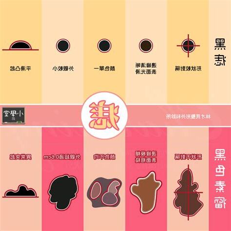 為甚麼會長痣