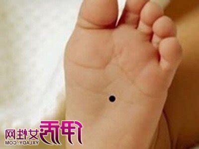 腳側邊有痣