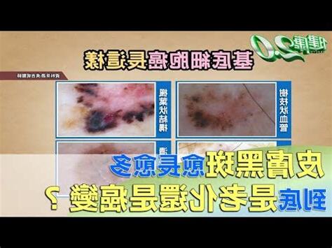 身體長黑斑