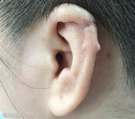 耳洞發炎腫起來