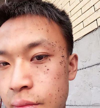 眼下黑斑