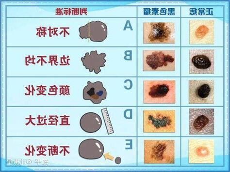 大黑痣