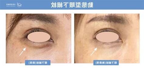 眼下細紋面相
