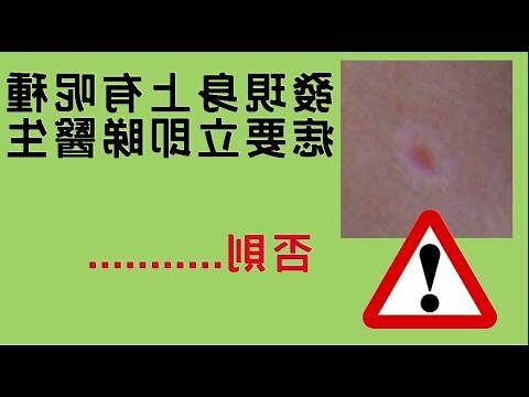 小手臂內側有痣