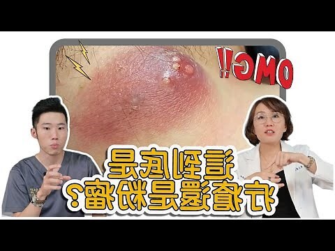 陰瘡