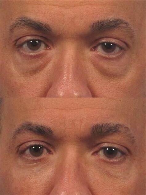 男人眼袋大面相