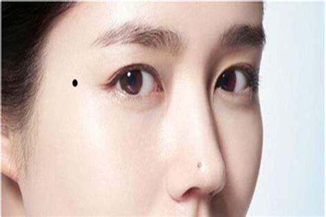 夫妻痣
