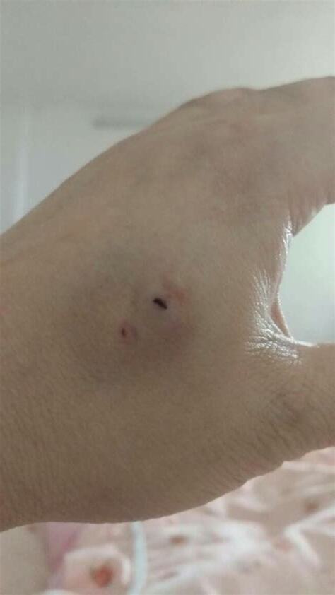 被老鼠咬會怎樣