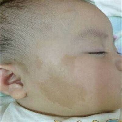咖啡牛奶斑嬰兒