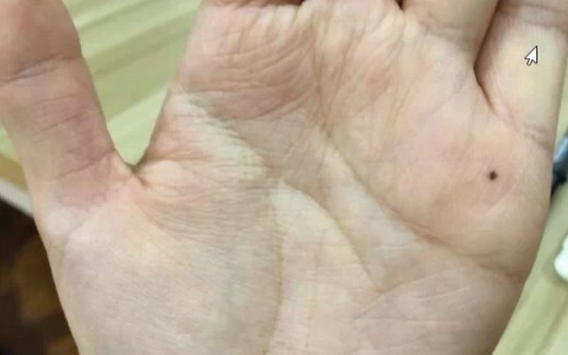 右手小指有痣