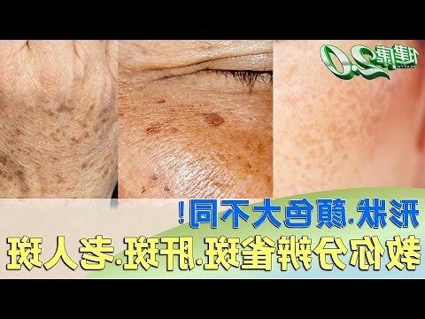 臉長斑