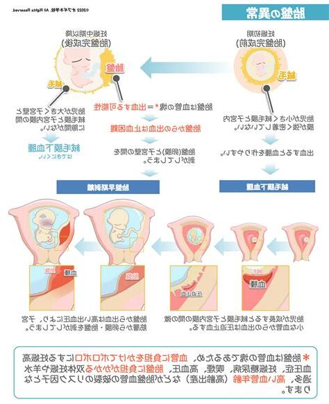 胎盤形成出血
