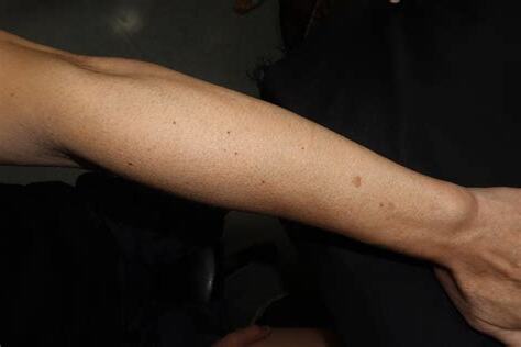 手臂突然長痣