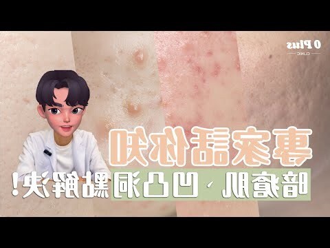 右下巴生暗瘡