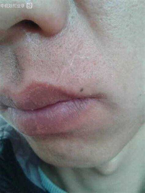 嘴唇疤痕