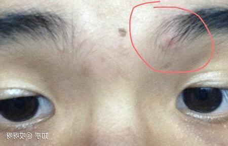 眉毛附近長痘痘