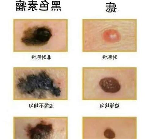 胸部有黑痣