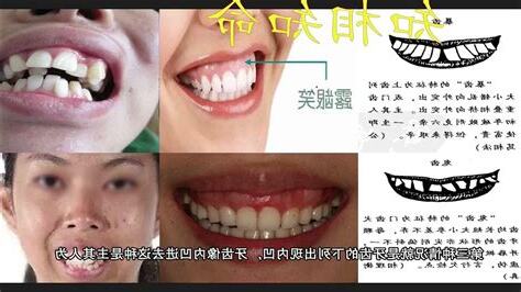 缺牙面相