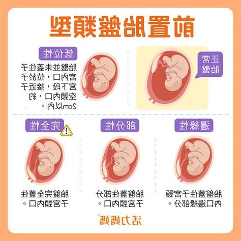 前置胎盤注意事項