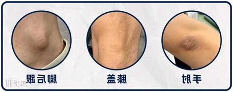 屁股黑斑