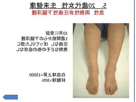 浮腫病