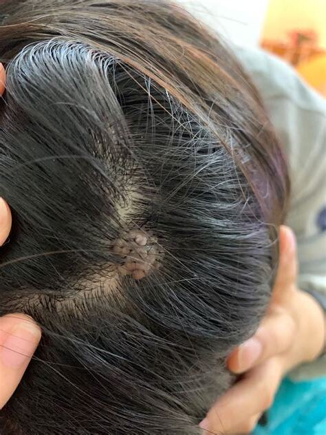 頭皮有痣