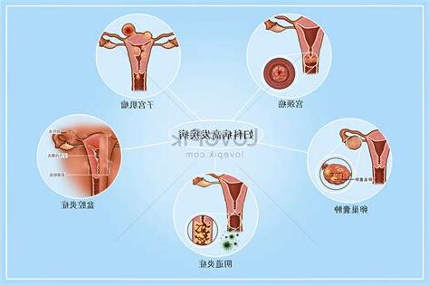 婦科病