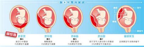 胎盤位置會變嗎