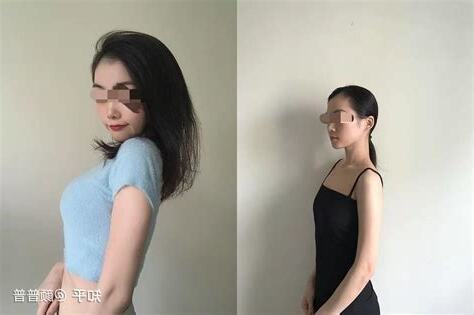 隆胸