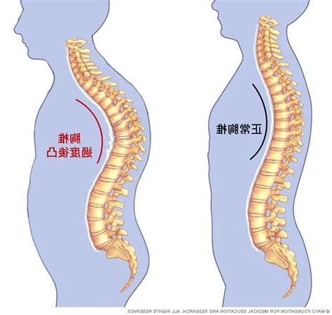 駝背造成的影響