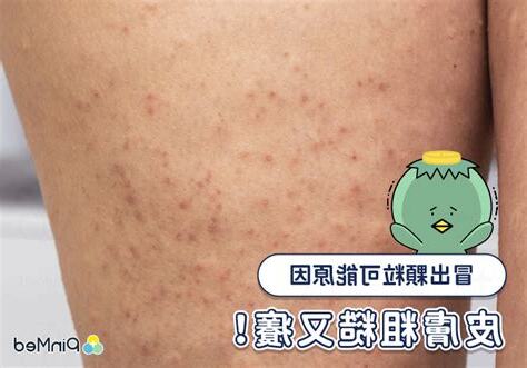 痕癢