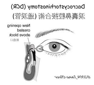淚管閉塞手術價錢