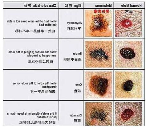 腰上的痣