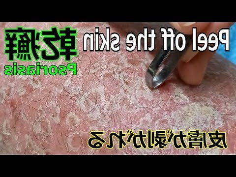 皮膚病