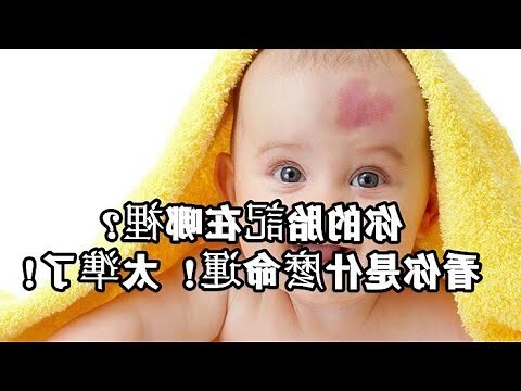 嬰兒胎記