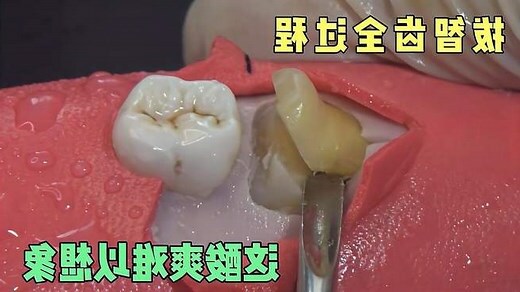 拔掉的牙齒怎麼處理