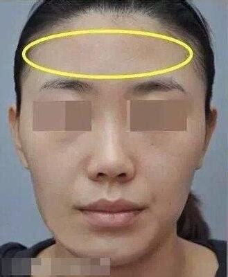 额头凹陷