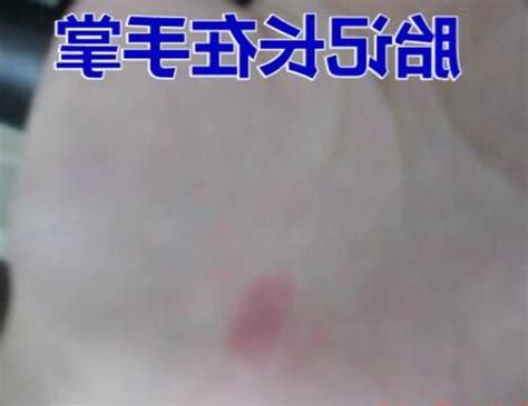 左手有胎記