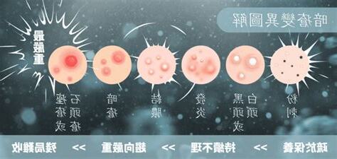 陰瘡