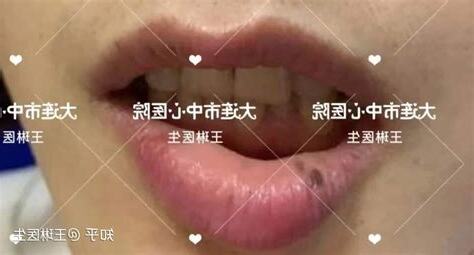 下嘴唇有黑斑