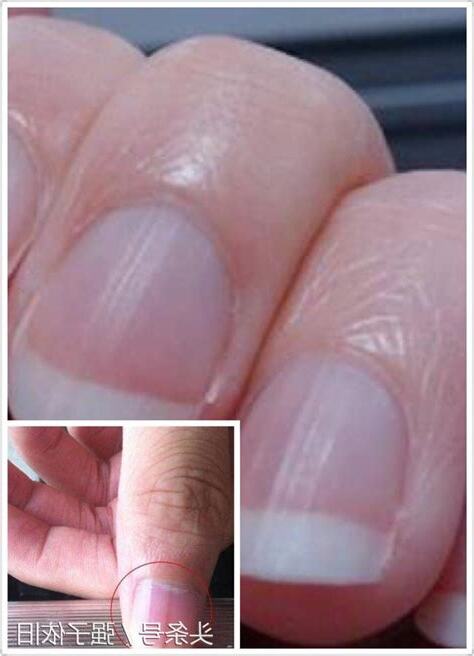 指甲凹