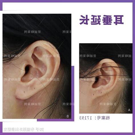 耳垂外翻