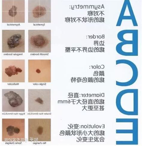 痣顏色