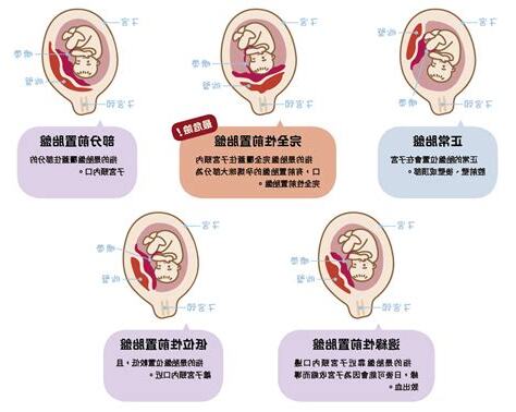 前置胎盤剝離