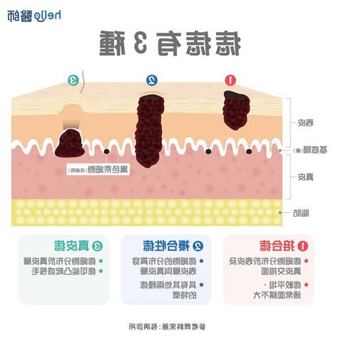 痣的形成